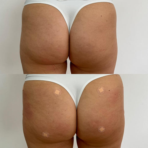 Can Non-Surgical Bum Lifts Help Enhance Waist-to-Hip Ratio?